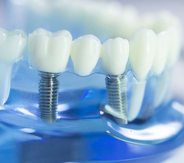 Memphis Dental Implants